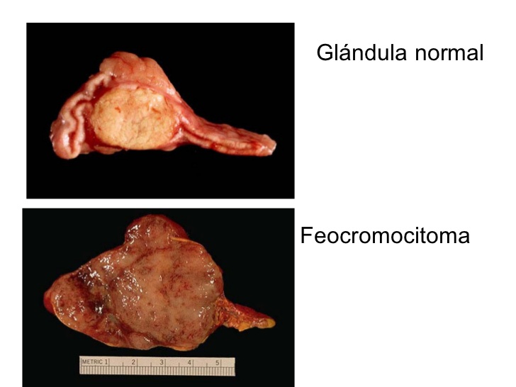 Representación de una glanadula normal afectada