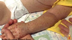 Las manchas rojas que tiene el niño de la imagen es un síntoma de esta enfermedad.