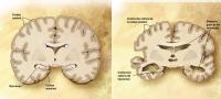 En esta imagen se puede ver como es un cerebro con Alzheimer y sin Alzheimer