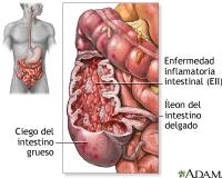 Imagen de una inflamación intestinal causada por la enfermedad de Crohn.