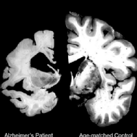 Interactivo: Aprende sobre el Alzheimer 