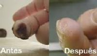 Regeneración de tejidos en un dedo.