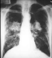 Radiografía con diagnóstico de fibrosis quística