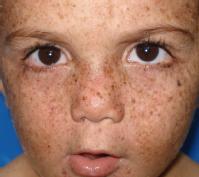 Niño afectado por la xerodermia pigmentosa.
