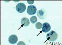 En la imagen observamos reticulocitos, que son glóbulos rojos que se consideran inmaduros o que no han terminado de formarse