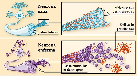Vemos como la acumulación de ovillos de tau pueden afectar mucho a una neurona si estos son muy grandes. Cuanto más disgregados mejor.
