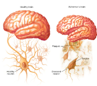 Las personas que padecen alzhéimer, tienen dañadas sus neuronas. Una causa tiene que ver con la acumulación de ovillos de Tau.