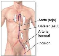 Cateterismo a través de la arteria femoral