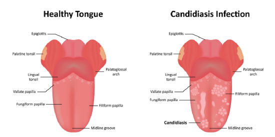 candidiasis oral