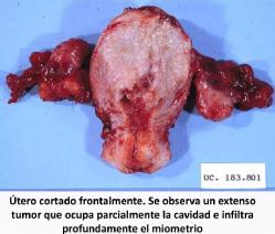 Foto de un útero con un tumor en el endometrio