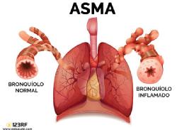 Como podemos observar al asma produce el estrechamiento de los bronquios