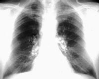 Imagen de una radiografía donde se ve esta enfermedad.