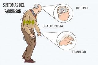 Síntomas de la enfermedad de Parkinson
