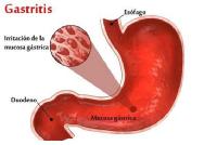 Procedencia: Porras, C. (2015, 3 mayo). La gastritis. Instituto Quirúrgico de Andalucía IQA.