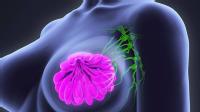 Foto de un pecho con el tejido mamario en lila