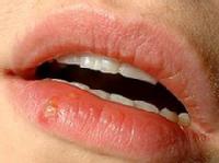 Herpes oral.