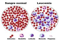 Así se ven las células de alguien con leucemia