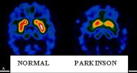 Comparación de un cerebro sano con un cerebro de un enfermo de párkinson