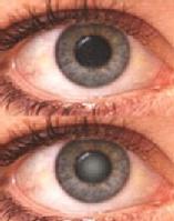En esta imagen apreciamos la diferencia entre un ojo sano y otro afectado por las cataratas.