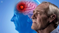 Esta enfermedad afecta principalmente al cerebro y a la gente de mayor edad 