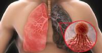 Foto en la que se muestra un tipo de cáncer del aparato respiratorio.